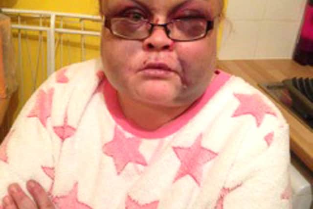 Sarah Mullings, 37, of Copnor, who suffered 70 blows when Karen Hanley, 37, of Eastern Road, attempted to murder Sarah between January 1 and 4, 2015. Hanley admitted
attempted murder at Portsmouth Crown Court on June 17, 2015.
Pictured: Sarah Mullings at Queen Alexandra Hospital in Cosham following the attack.