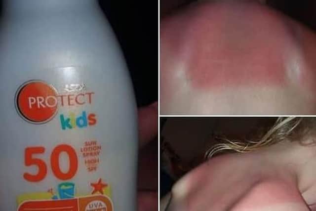 Kids sunburned after wearing factor 50 sun cream. Picture: The i