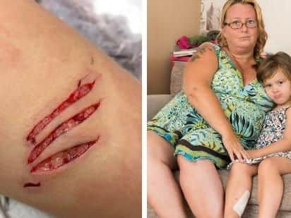 Lily Jones with her mother Lisa Perkins, and the injuries