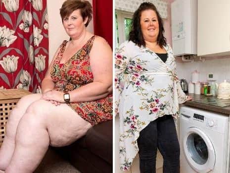 Claire Tickle, before and after her procedure. Pictures: SWNS