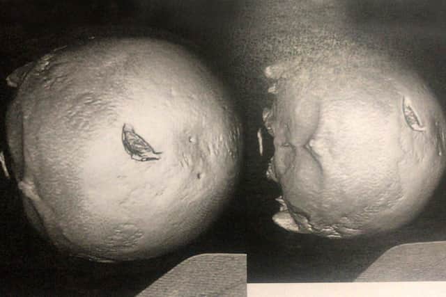 Photo shows a medical scan of Darren Selway's skull after he was attacked with a crowbar. Picture: Ashley Selway