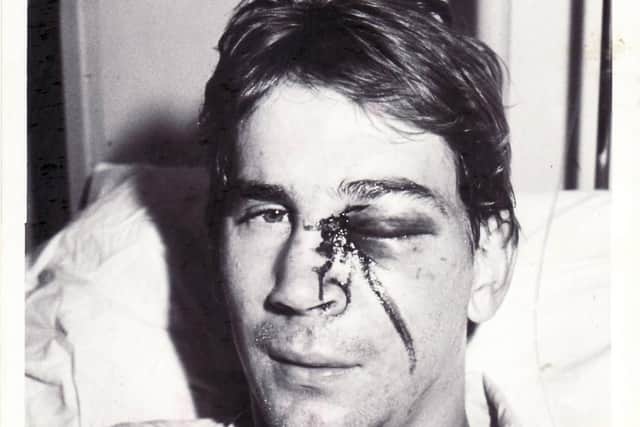 The Legend was hospitalised after being elbowed by Wimbleldons Eric Young in 1988, leaving the keeper with serious facial injuries