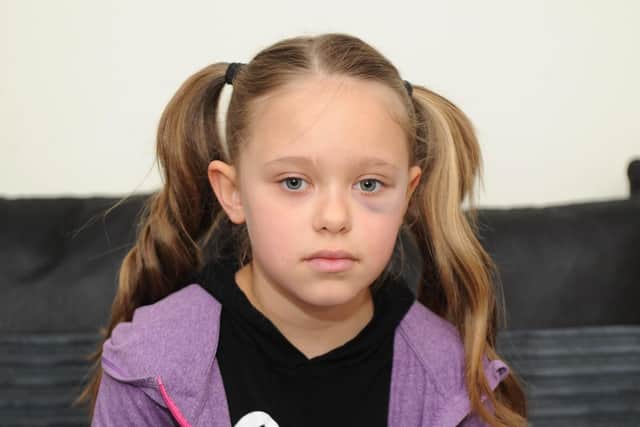 Tia Gash, nine, has been left with a black eye after she was attacked along Goldsmith Avenue by a man she didn't know when she walked home from school, on Thursday. Picture: Habibur Rahman