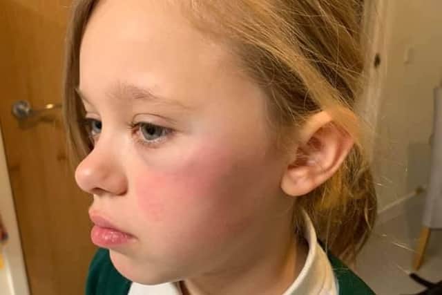 Tia's face immediately after she got home following the attack. Picture: Helen Gash