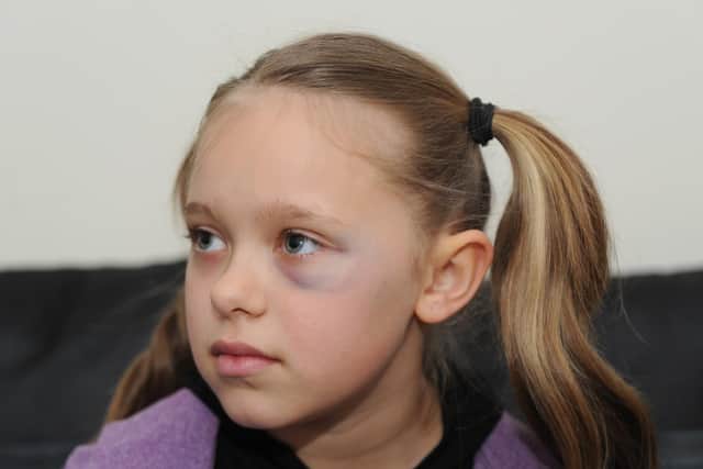 Tia Gash, nine, and the black eye she suffered after a man she didn't know slapped her in the street. Picture: Habibur Rahman