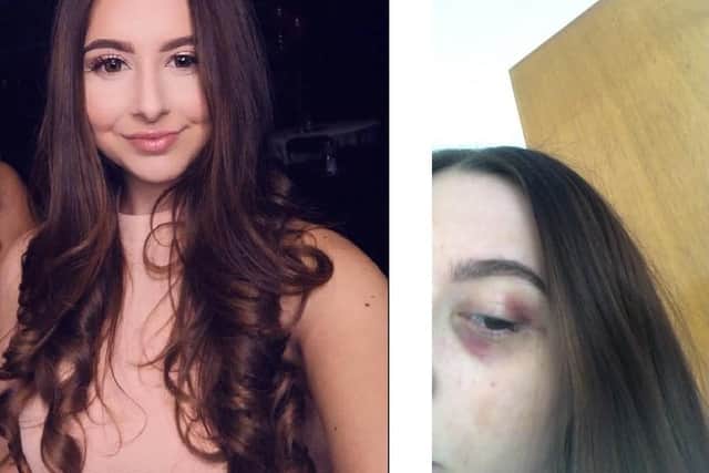 Left, Niaomi Blackstock and, right, her black eye after she was punched in Friday's attack