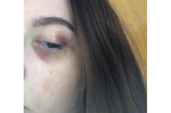 The black eye Niaomi Blackstock suffered after she was attacked on Friday morning. Picture: Niaomi Blackstock