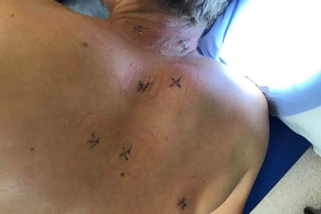 Victim Nathan Birch was stabbed 17 times by Ashley Luff. Pictures show 24-year-old chef Nathan in hospital after the attack on August 19, 2018, in Southampton Road in Park Gate. Pictures: Nathan Birch