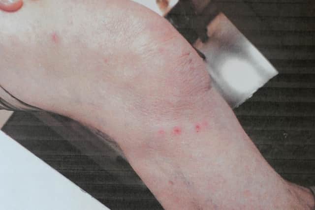 Bed bug bites on Jennifer's leg