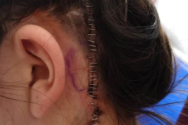 The scar left after the surgery