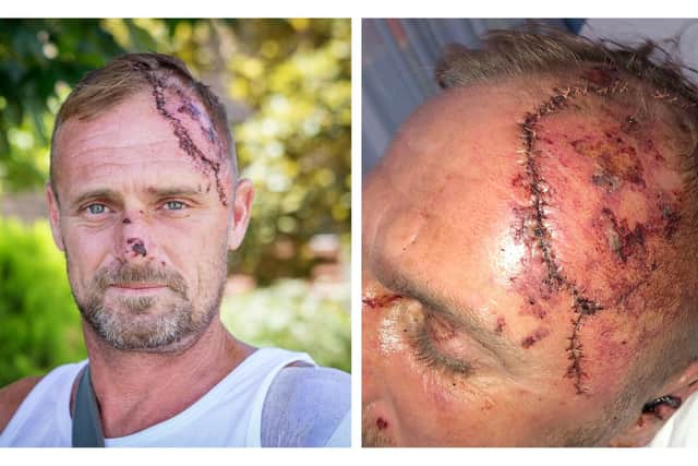 Mark Ward at his mother's home in Waterlooville, and his injuries (right). Picture: Habibur Rahman