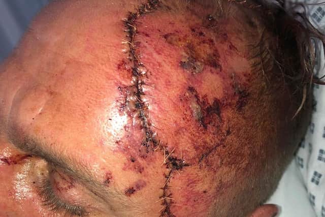 Groundworker Mark Ward, 40, needed 200 stitches on his head after coming off his bike in Eastern Road, Portsmouth, on July 21. Picture: Mike Ward