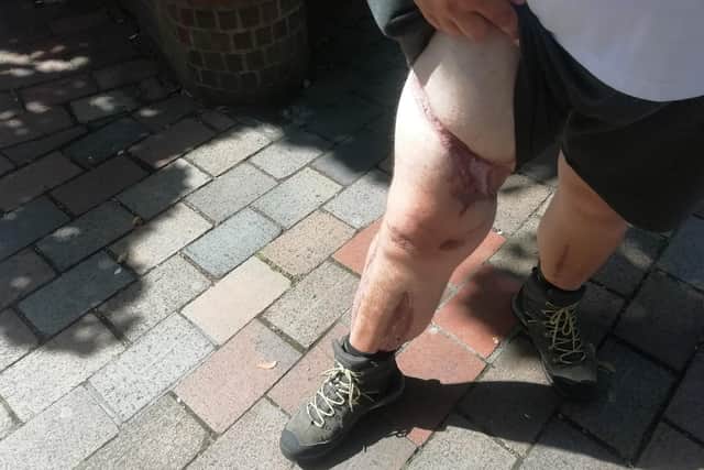 Motorcyclist Ray Chandler, 25 from Waterlooville, and the injuries to his right leg when he was hit with a car being driven by Michael Woods. Picture: David George
