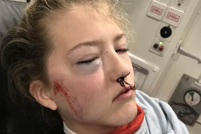 Mei Jones, 13, after being hit by a car in a hit-and-run as she went to catch the bus to Swanmore College in Warnford Road, the A32, on Tuesday, October 8. Picture: Kate Jones