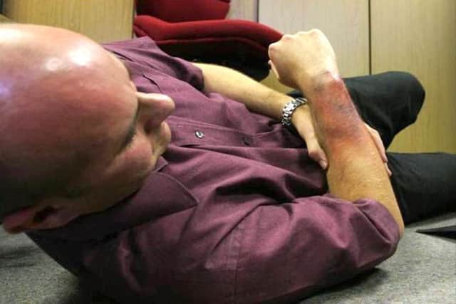 St John Ambulance gives advice on how to treat bruising and blisters