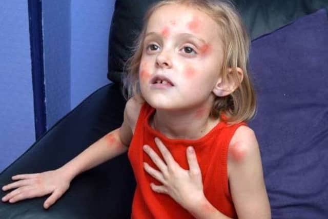 CAP: St John Ambulance gives advice on how to treat an allergic reaction