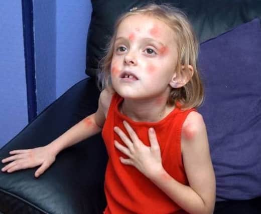 CAP: St John Ambulance gives advice on how to treat an allergic reaction