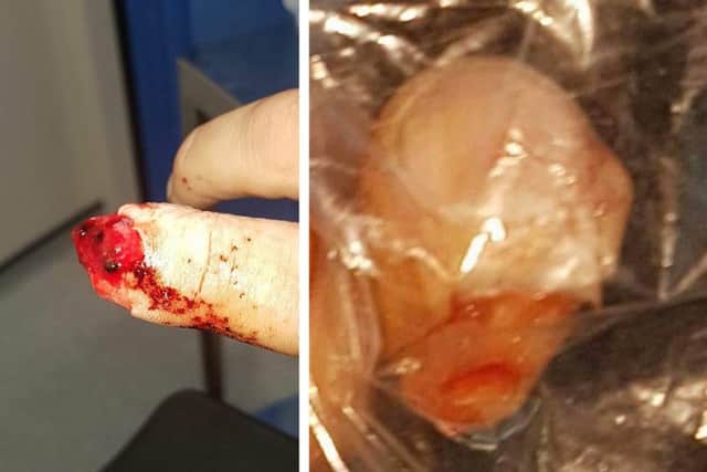 Mickey Parker's finger following the accident and, right, the severed tip