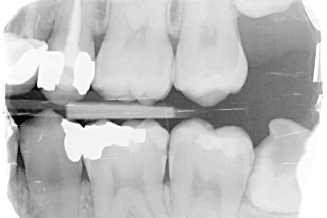 X-Ray images showing problems with Alex Harling's teeth. 
Picture: The Dental Law Partnership