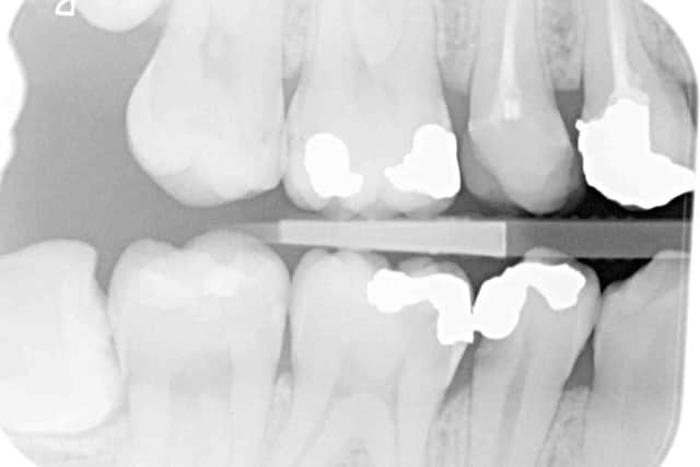 X-Ray images showing problems with Alex Harling's teeth.