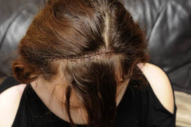 The scar where surgeons had to cut open Megan's head