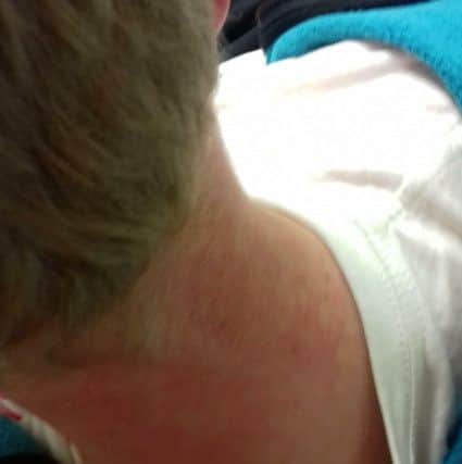 Red marks on Landen Holt's neck from being throttled Picture: Kerry Holt