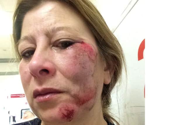 Pauline Lympany of Cosham came off her bike on the A27 in Portchester on Sunday, June 10, 2018. She is warning others to wear a helmet