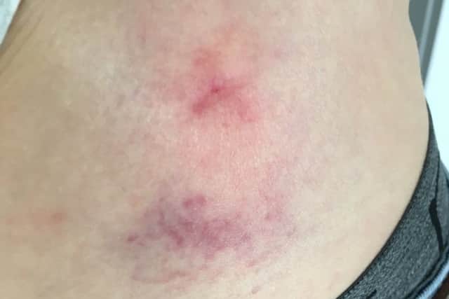 The injury on Mr Chambers' right hip