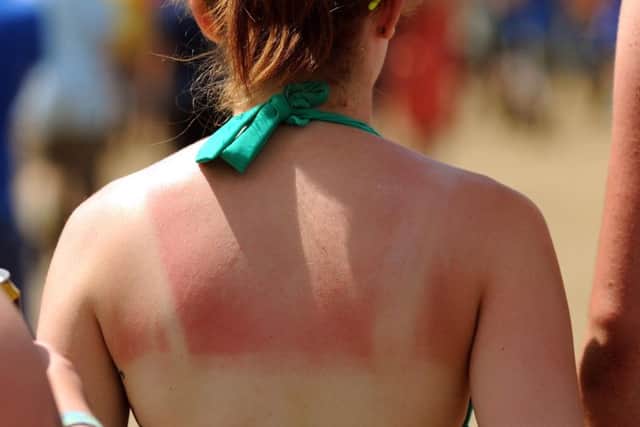Did you get sunburnt over the weekend? Picture: Anthony Devlin/PA Wire