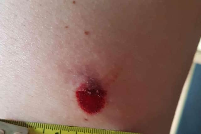 The welt left on Mr Robinson's right-side after he was targeted by the so-called 'cycle sniper' while out on a ride