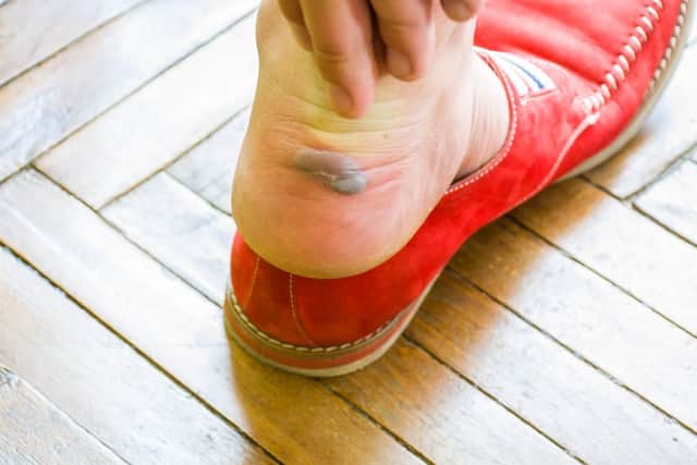 St John Ambulance gives advice on how to treat blisters