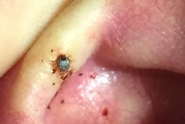 A close-up of the tick bite Keith Poultney suffered on the back of his ear during what was supposed to be the trip of a lifetime to Nepal