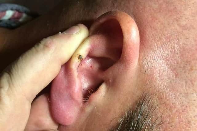 The tick embedded in Keith Poultney's ear after he was bitten during a trip to Nepal