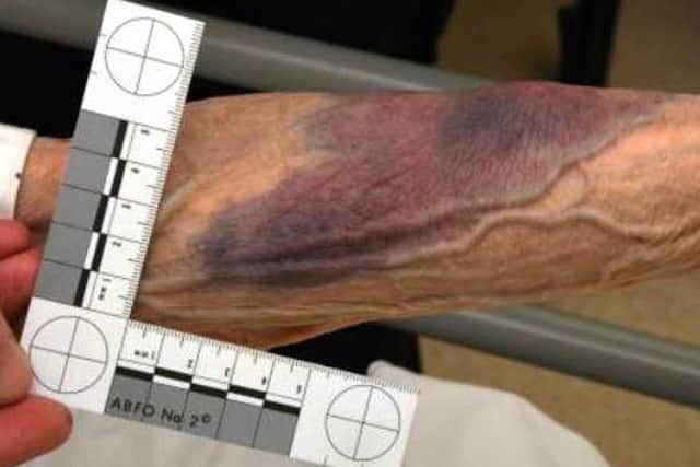 The injuries Ms Kaczan suffered as a result of the robbery. Picture: Derbyshire Police/PA Wire