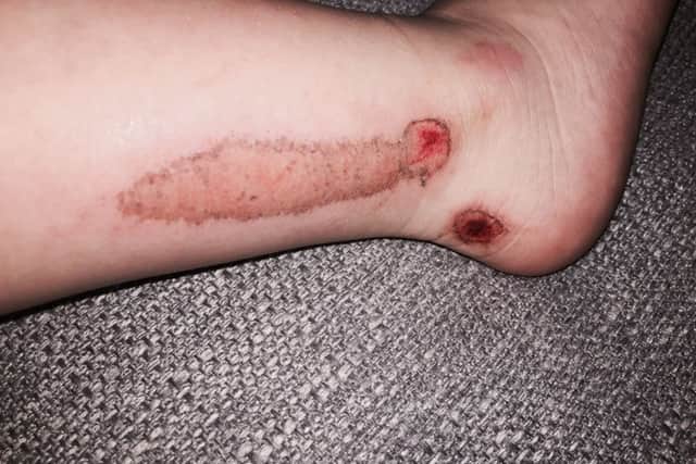 The injury to Bobby Bradley's foot and leg caused by the scooter in Waterlooville