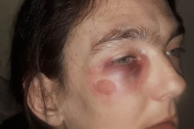 The injuries to Ms West's face after the attack.