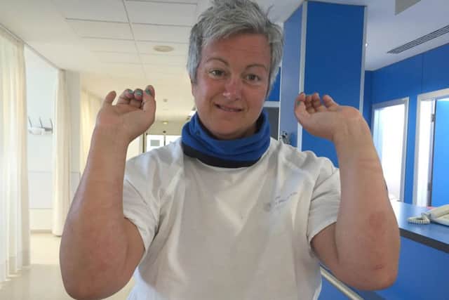 Anna Wardley after being discharged from hospital after being stung by jellyfish during her Menorca swim
