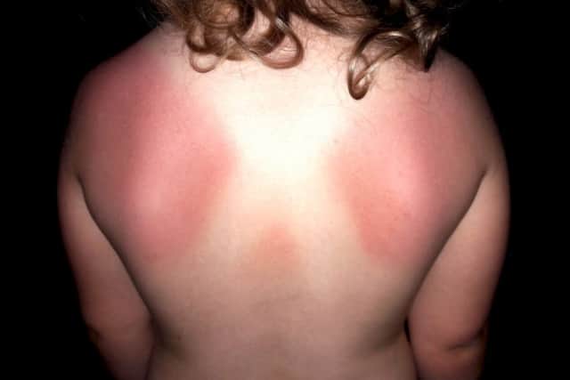 Stephanie Ross took this picture of the sunburn on her three-year-old daughter Amber's back