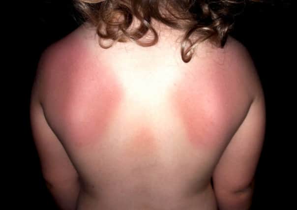 Stephanie Ross took this picture of the sunburn on her three-year-old daughter Amber's back