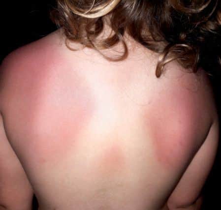 jpns-29-06-16-017 sunburn rep lcAmber Ross sunburnpicture supplied by Stephanie RossFrom: Steph Ross 