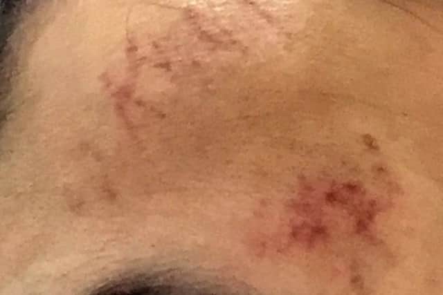 Injuries to the man attacked by a gang in Kingston Park