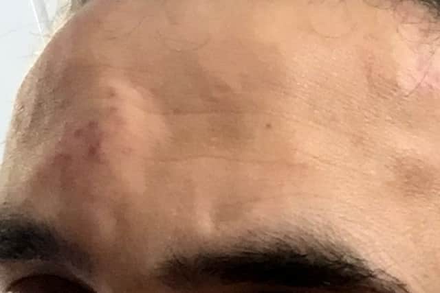 Injuries to the man attacked by a gang in Kingston Park