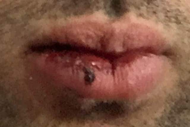 Injuries to the man attacked by a gang in Kingston Park