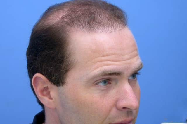 David Anderson when he was suffering from hair loss
