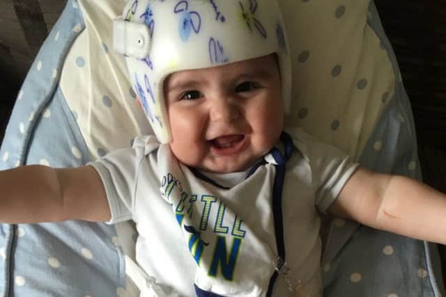 Eight-month-old Albert Crook needs a custom-fitted helmet to tackle his flat head syndrome