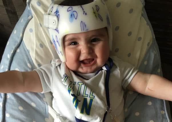 Eight-month-old Albert Crook needs a custom-fitted helmet to tackle his flat head syndrome