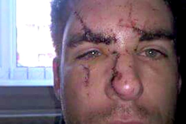 Ashley Donald after he was glassed in the face at Bar 38 in Gunwharf Quays