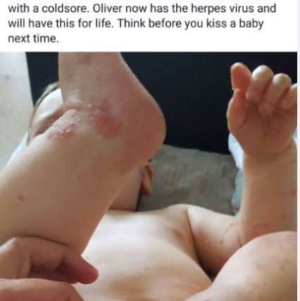 Amy Stinton of Portsmouth took this picture of her 14-month-old son Oliver after he contracted the herpes simplex virus and came out in blisters