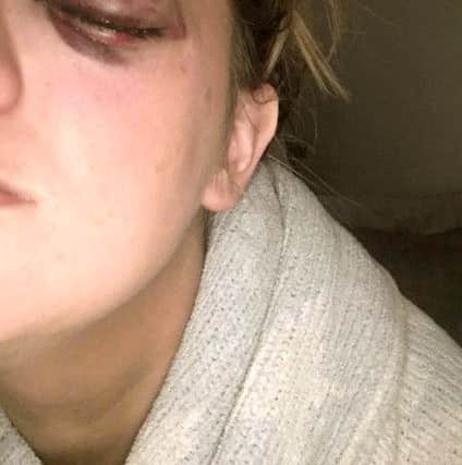 Kayleigh Reid's fractured eye socket
