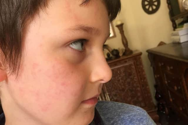 Leah Mead's son showing his bed bug bites